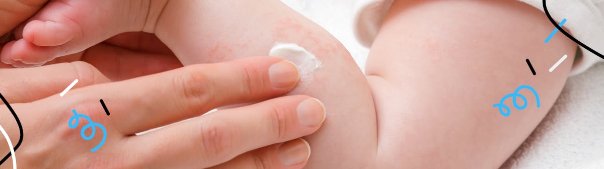 Comment parler aux parents de la dermatite atopique sur un ton expert et déculpabilisant ?